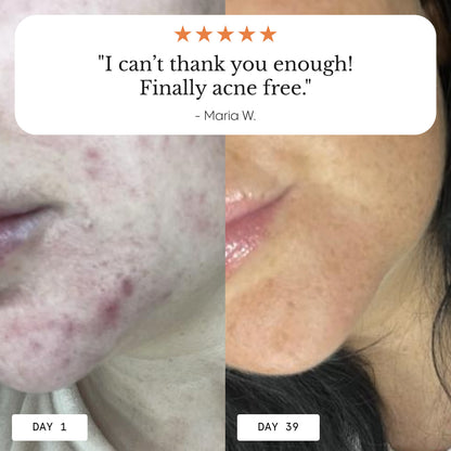 Balm for Acne-Prone Skin